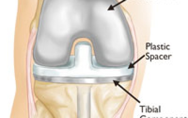 How old is too Young for Hip and knee arthroplasty