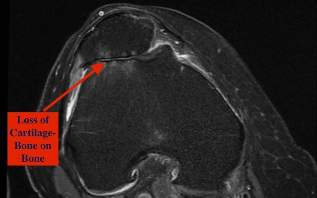 Patella-Femoral Joint Arthritis